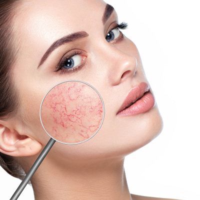 Rosacea-Treatment-in-Islamabad-Rawalpindi-Pakistan