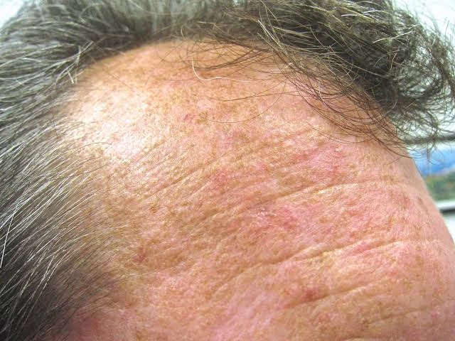 What Is Actinic Keratosis? Signs of Sun-Damaged Skin to Watch For